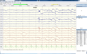 EEG of brain and heart action on opening the eyes. Photo by Otoomuch via Wikimedia Commons