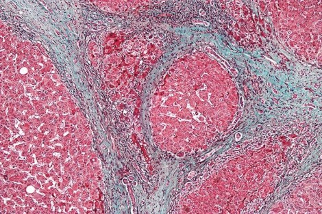 High magnification micrograph of a liver with cirrhosis, a disease in which healthy liver tissue is replaced with scar tissue. (Nephron/Wikimedia Commons)